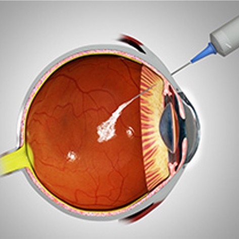 Retinset eye drops
